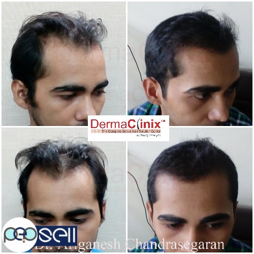 How to do Hair Transplant Surgery inÂ Chennai 0 